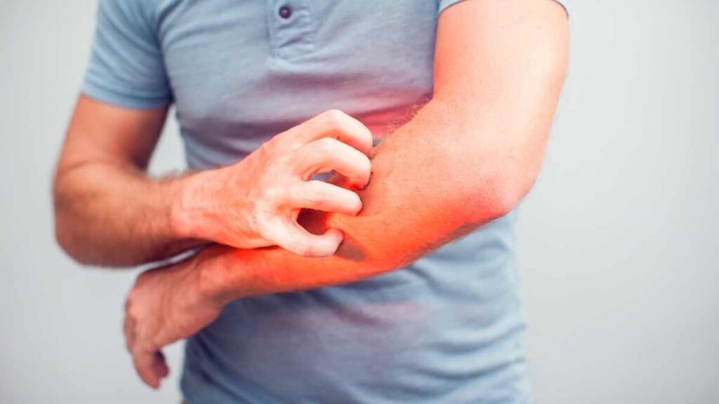 man scratching mosquito bites