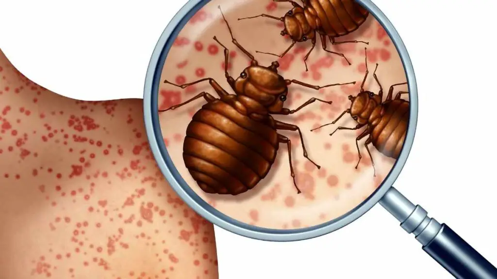 bed bug bites